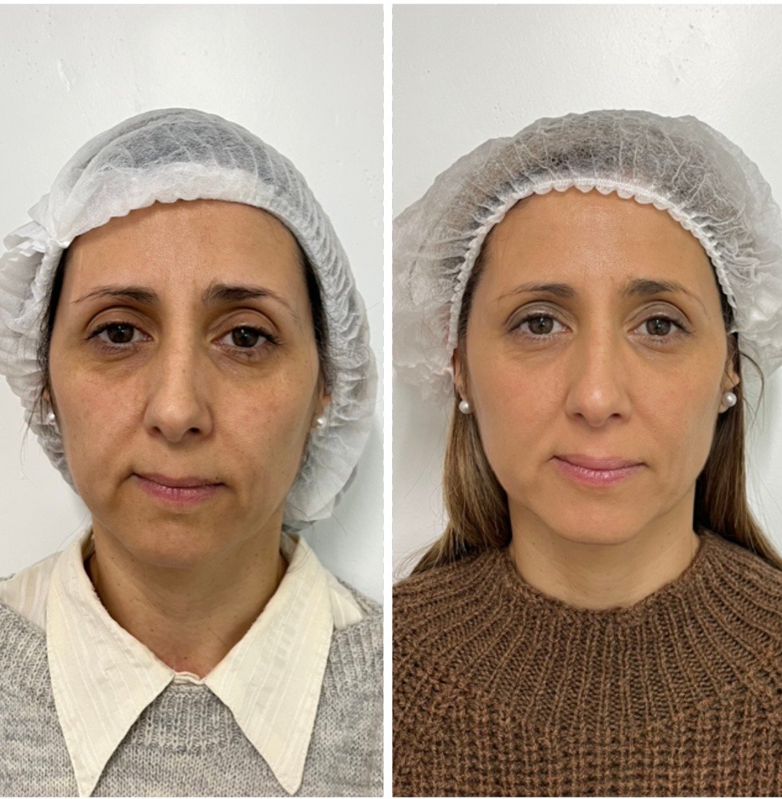 veca-veronica-carca-abal-médica-endocrinologa-metabolismo- climaterio-y- menopausia-salud-hormonal- longevidad-y medicina-estetica-bioestimulacion- con-sculptra