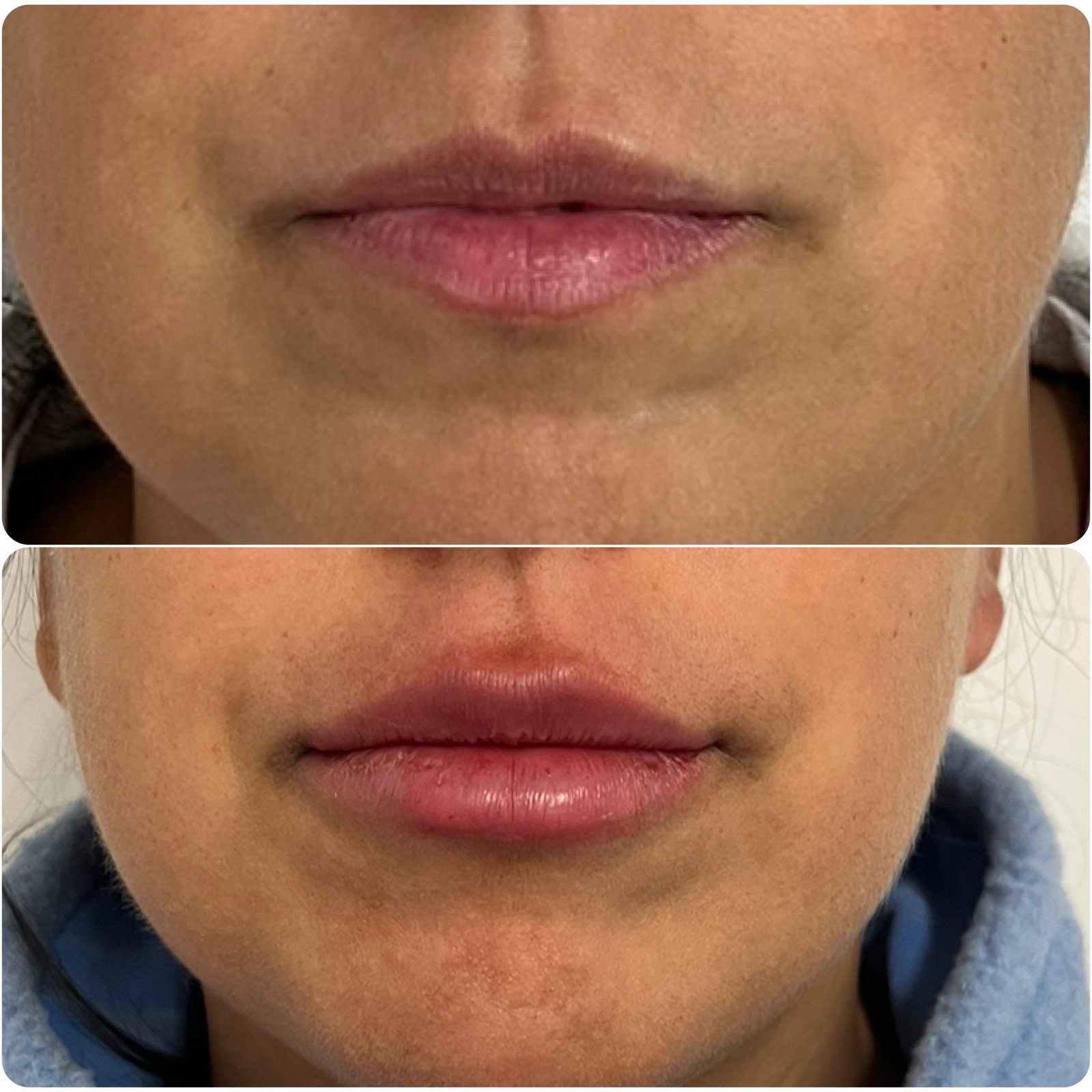 veca-veronica-carca-abal-médica-endocrinologa-metabolismo- climaterio-y- menopausia-salud-hormonal- longevidad-y medicina-estetica-servicios-relleno-de-labios