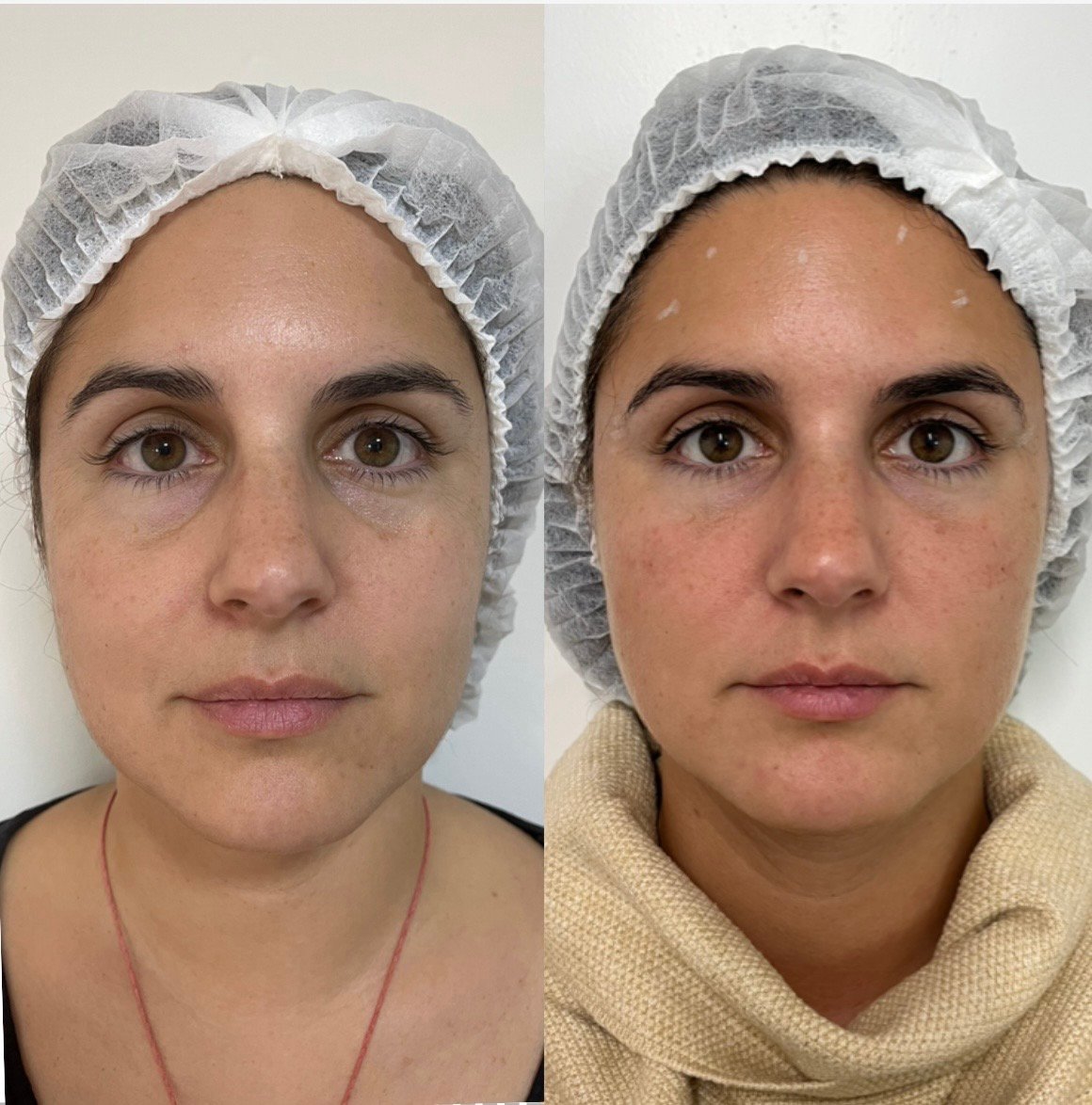 veca-veronica-carca-abal-médica-endocrinologa-metabolismo- climaterio-y- menopausia-salud-hormonal- longevidad-y medicina-estetica-servicios-reposicion-de- pómulos-y-relleno-de- ojeras